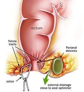 Perianal abscess