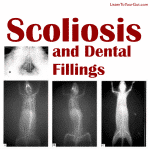 Scoliosis and Dental Fillings