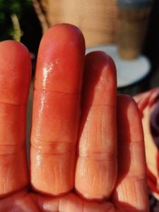 Fingers immediately after sting