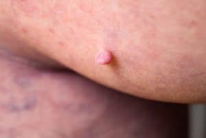 large mole on the foot, removal of moles or warts, skin tags