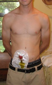 Male J-Pouch for Ileostomy